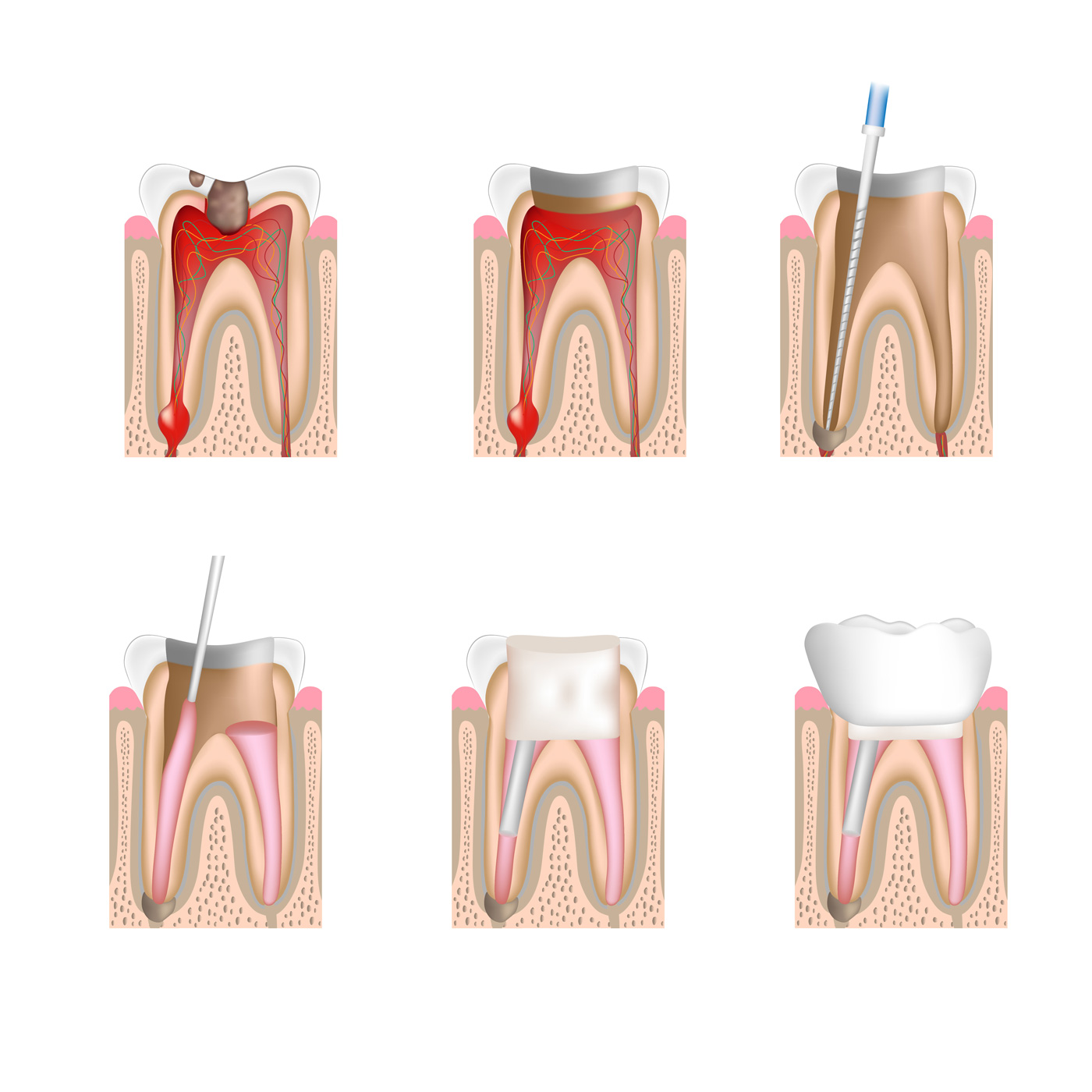 Root Canal | Richrose Dental